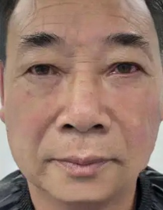 去眼袋手术