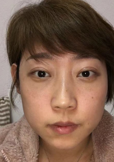 去眼袋手术