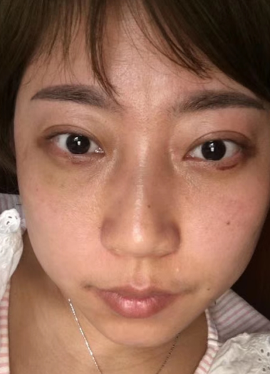 去眼袋手术