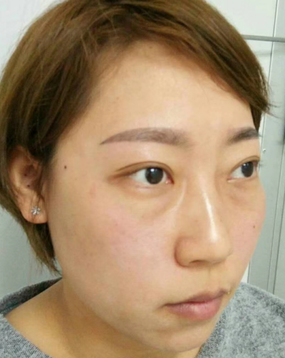 去眼袋手术