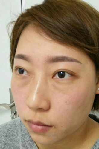 去眼袋手术