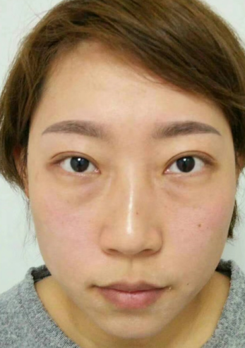 去眼袋手术