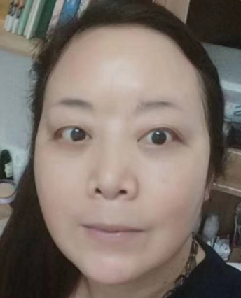 去眼袋手术