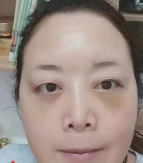 去眼袋手术