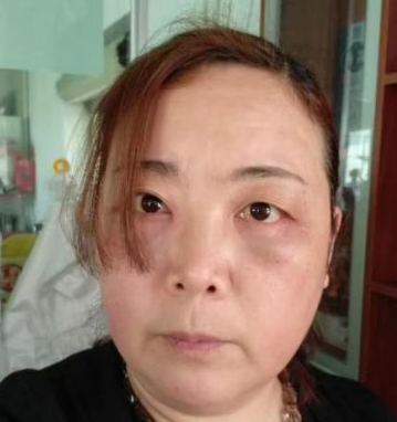 去眼袋手术