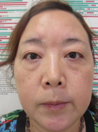 去眼袋手术