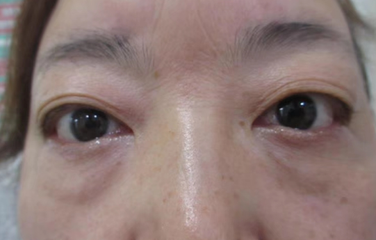 去眼袋手术