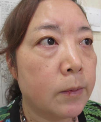 去眼袋手术