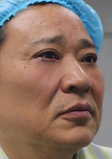 去眼袋手术