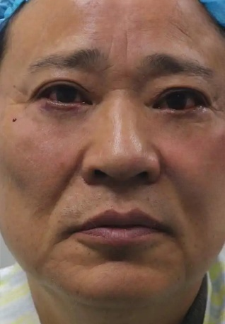 去眼袋手术