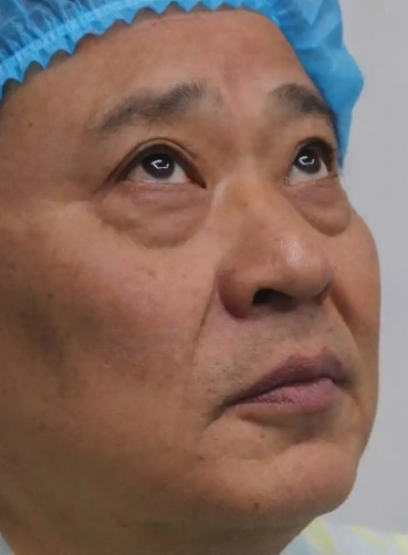 去眼袋手术