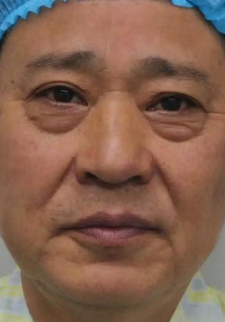 去眼袋手术