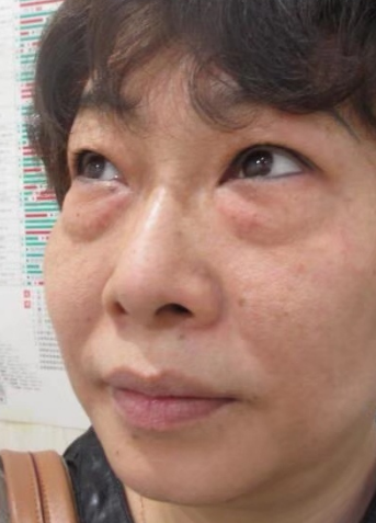 去眼袋手术