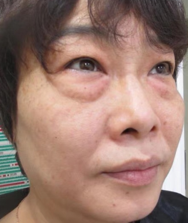 去眼袋手术