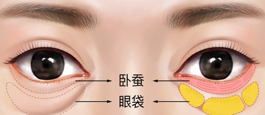 去眼袋手术