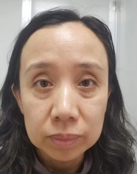 去眼袋手术
