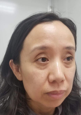 去眼袋手术