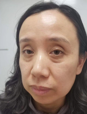 去眼袋手术