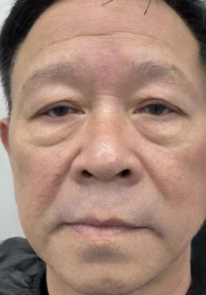去眼袋手术