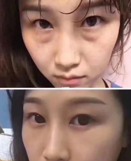 去眼袋手术