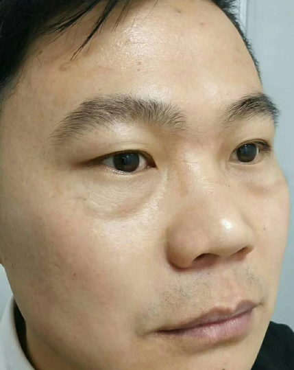去眼袋手术