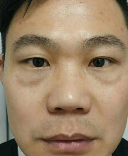 去眼袋手术