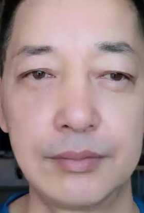去眼袋手术
