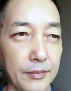 去眼袋手术