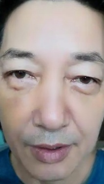 去眼袋手术