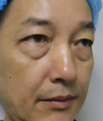 去眼袋手术