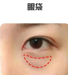 去眼袋手术