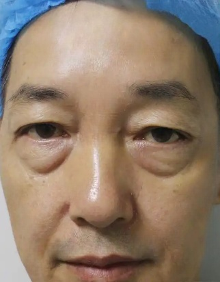 去眼袋手术