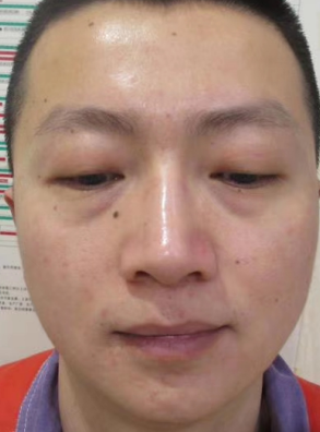 去眼袋手术