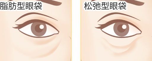 去眼袋手术
