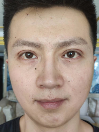 去眼袋手术