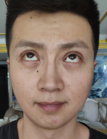 去眼袋手术