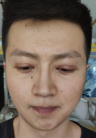 去眼袋手术