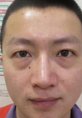 去眼袋手术