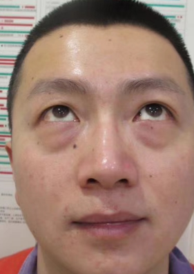 去眼袋手术