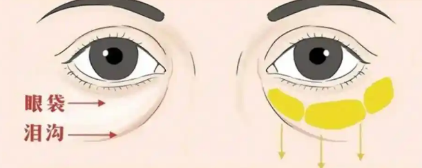 去眼袋手术