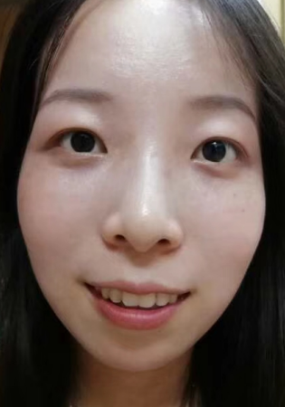 去眼袋手术