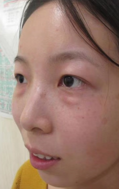 去眼袋手术