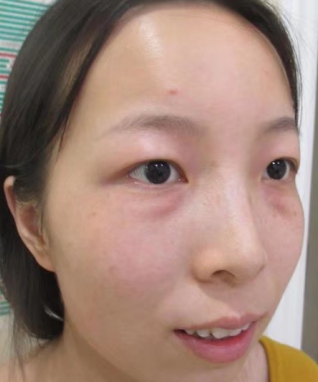 去眼袋手术