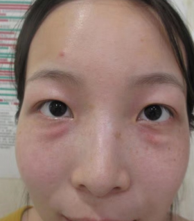 去眼袋手术