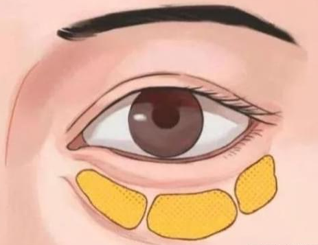 去眼袋手术