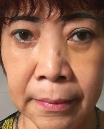 去眼袋手术