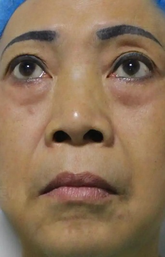 去眼袋手术