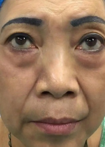 去眼袋手术