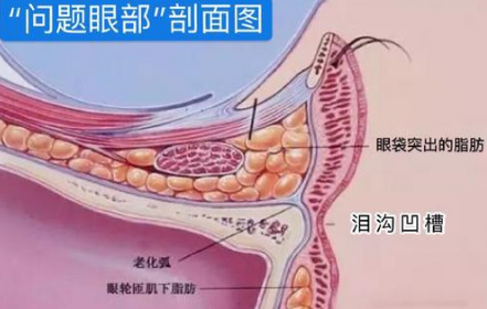 眼袋