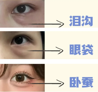 眼袋